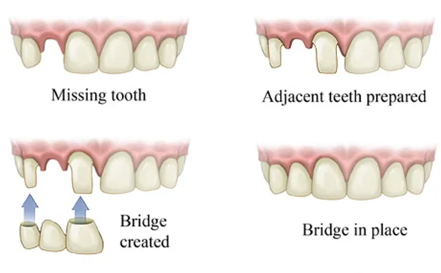 Twin Branch Dental Dental, 309 Bittersweet Road #105 Mishawaka, IN 46544, Emergencies Same Day, Clear Aligners, Orthodontics, Orthodontist, Teeth Whitening, Same Day Wisdom Tooth Extractions, Same Day Endodomtics, Endodontist, Root Canals, dental veneers, implants, implant, crown, crowns, veneer, Bridges, bridge, fillings, sealants flouride treatment, dental exams, x-rays, teeth cleanings, childs first dental visit, General dentistry, emergency dentistry, cosmetic dentistry, restorative dentistry, preventative dentistry, dentures, denture partial full, periodontal therapy, sedation dentistry, Dr. Mike Hewlett and Dr. Andrew Zaremba