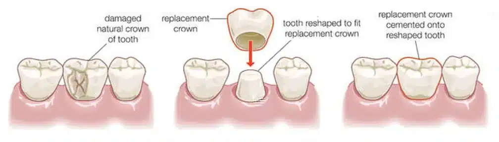 Twin Branch Dental Dental, 309 Bittersweet Road #105 Mishawaka, IN 46544, Emergencies Same Day, Clear Aligners, Orthodontics, Orthodontist, Teeth Whitening, Same Day Wisdom Tooth Extractions, Same Day Endodomtics, Endodontist, Root Canals, dental veneers, implants, implant, crown, crowns, veneer, Bridges, bridge, fillings, sealants flouride treatment, dental exams, x-rays, teeth cleanings, childs first dental visit, General dentistry, emergency dentistry, cosmetic dentistry, restorative dentistry, preventative dentistry, dentures, denture partial full, periodontal therapy, sedation dentistry, Dr. Mike Hewlett and Dr. Andrew Zaremba