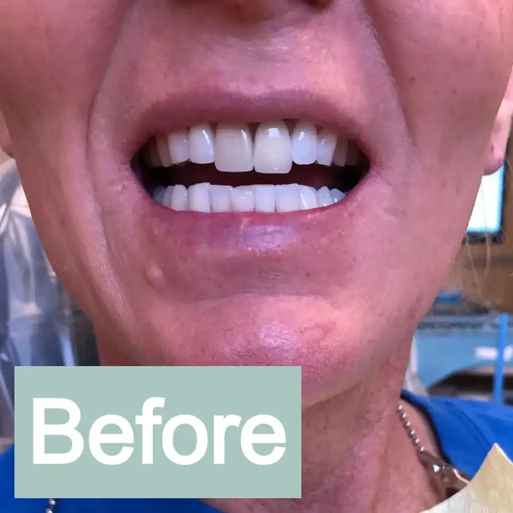 Twin Branch Dental Dental, 309 Bittersweet Road #105 Mishawaka, IN 46544, Emergencies Same Day, Clear Aligners, Orthodontics, Orthodontist, Teeth Whitening, Same Day Wisdom Tooth Extractions, Same Day Endodomtics, Endodontist, Root Canals, dental veneers, implants, implant, crown, crowns, veneer, Bridges, bridge, fillings, sealants flouride treatment, dental exams, x-rays, teeth cleanings, childs first dental visit, General dentistry, emergency dentistry, cosmetic dentistry, restorative dentistry, preventative dentistry, dentures, denture partial full, periodontal therapy, sedation dentistry, Dr. Mike Hewlett and Dr. Andrew Zaremba