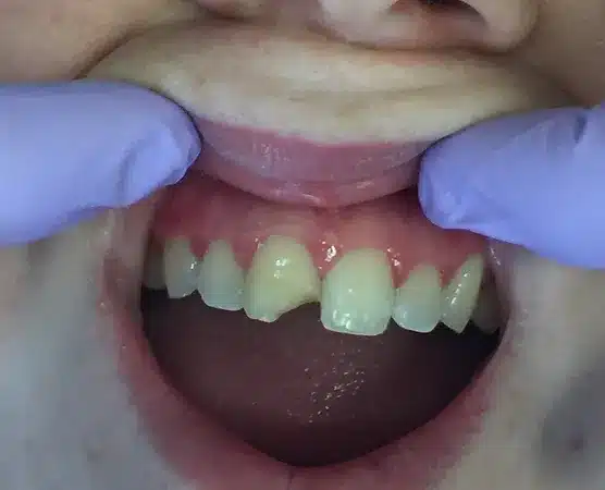 Twin Branch Dental Dental, 309 Bittersweet Road #105 Mishawaka, IN 46544, Emergencies Same Day, Clear Aligners, Orthodontics, Orthodontist, Teeth Whitening, Same Day Wisdom Tooth Extractions, Same Day Endodomtics, Endodontist, Root Canals, dental veneers, implants, implant, crown, crowns, veneer, Bridges, bridge, fillings, sealants flouride treatment, dental exams, x-rays, teeth cleanings, childs first dental visit, General dentistry, emergency dentistry, cosmetic dentistry, restorative dentistry, preventative dentistry, dentures, denture partial full, periodontal therapy, sedation dentistry, Dr. Mike Hewlett and Dr. Andrew Zaremba