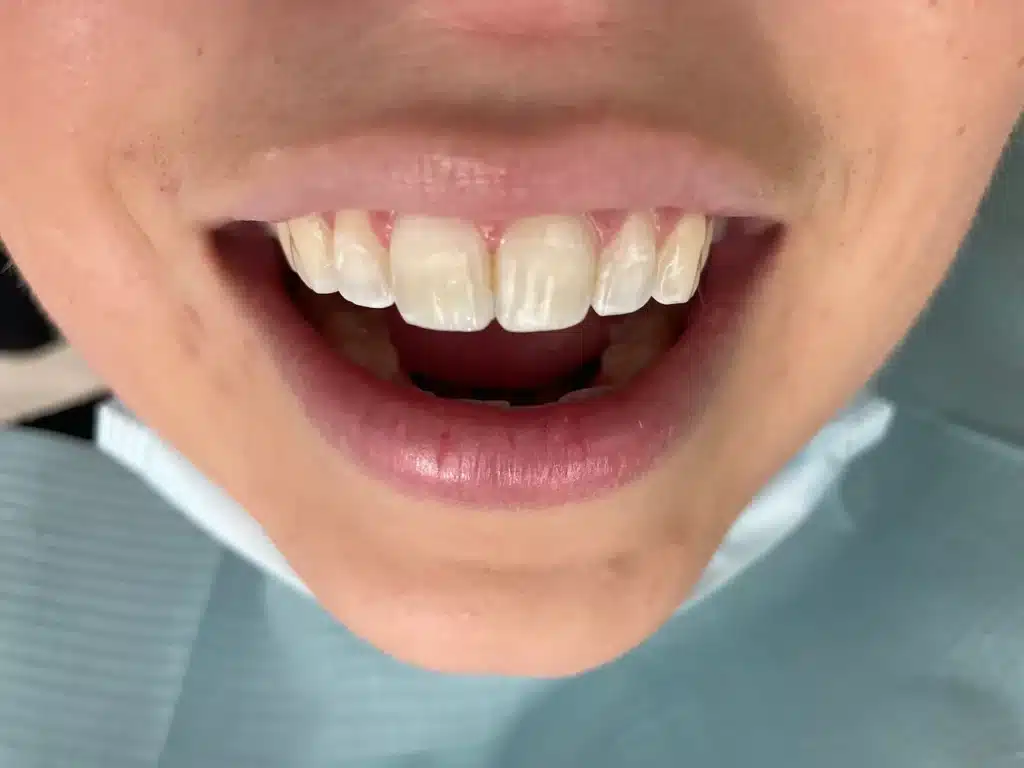 Twin Branch Dental Dental, 309 Bittersweet Road #105 Mishawaka, IN 46544, Emergencies Same Day, Clear Aligners, Orthodontics, Orthodontist, Teeth Whitening, Same Day Wisdom Tooth Extractions, Same Day Endodomtics, Endodontist, Root Canals, dental veneers, implants, implant, crown, crowns, veneer, Bridges, bridge, fillings, sealants flouride treatment, dental exams, x-rays, teeth cleanings, childs first dental visit, General dentistry, emergency dentistry, cosmetic dentistry, restorative dentistry, preventative dentistry, dentures, denture partial full, periodontal therapy, sedation dentistry, Dr. Mike Hewlett and Dr. Andrew Zaremba