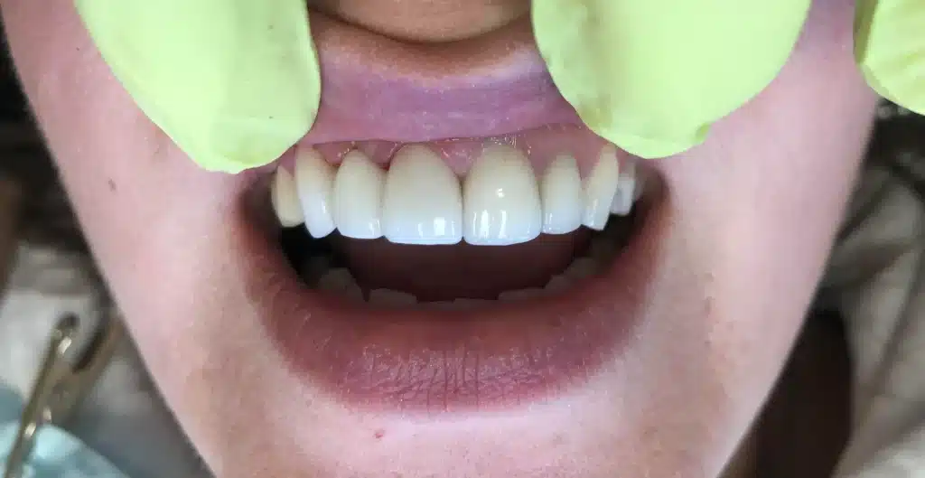 Twin Branch Dental Dental, 309 Bittersweet Road #105 Mishawaka, IN 46544, Emergencies Same Day, Clear Aligners, Orthodontics, Orthodontist, Teeth Whitening, Same Day Wisdom Tooth Extractions, Same Day Endodomtics, Endodontist, Root Canals, dental veneers, implants, implant, crown, crowns, veneer, Bridges, bridge, fillings, sealants flouride treatment, dental exams, x-rays, teeth cleanings, childs first dental visit, General dentistry, emergency dentistry, cosmetic dentistry, restorative dentistry, preventative dentistry, dentures, denture partial full, periodontal therapy, sedation dentistry, Dr. Mike Hewlett and Dr. Andrew Zaremba