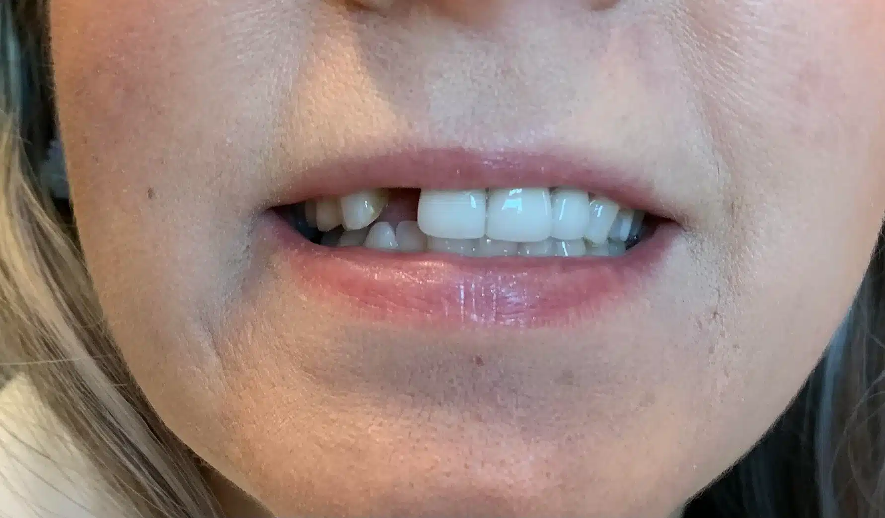 Twin Branch Dental Dental, 309 Bittersweet Road #105 Mishawaka, IN 46544, Emergencies Same Day, Clear Aligners, Orthodontics, Orthodontist, Teeth Whitening, Same Day Wisdom Tooth Extractions, Same Day Endodomtics, Endodontist, Root Canals, dental veneers, implants, implant, crown, crowns, veneer, Bridges, bridge, fillings, sealants flouride treatment, dental exams, x-rays, teeth cleanings, childs first dental visit, General dentistry, emergency dentistry, cosmetic dentistry, restorative dentistry, preventative dentistry, dentures, denture partial full, periodontal therapy, sedation dentistry, Dr. Mike Hewlett and Dr. Andrew Zaremba