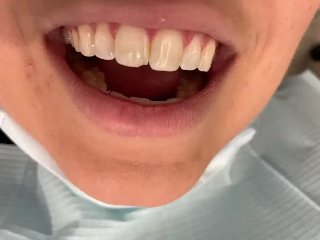 Twin Branch Dental Dental, 309 Bittersweet Road #105 Mishawaka, IN 46544, Emergencies Same Day, Clear Aligners, Orthodontics, Orthodontist, Teeth Whitening, Same Day Wisdom Tooth Extractions, Same Day Endodomtics, Endodontist, Root Canals, dental veneers, implants, implant, crown, crowns, veneer, Bridges, bridge, fillings, sealants flouride treatment, dental exams, x-rays, teeth cleanings, childs first dental visit, General dentistry, emergency dentistry, cosmetic dentistry, restorative dentistry, preventative dentistry, dentures, denture partial full, periodontal therapy, sedation dentistry, Dr. Mike Hewlett and Dr. Andrew Zaremba