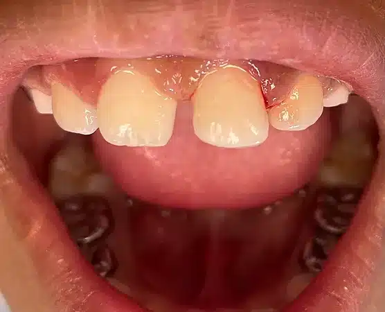 Twin Branch Dental Dental, 309 Bittersweet Road #105 Mishawaka, IN 46544, Emergencies Same Day, Clear Aligners, Orthodontics, Orthodontist, Teeth Whitening, Same Day Wisdom Tooth Extractions, Same Day Endodomtics, Endodontist, Root Canals, dental veneers, implants, implant, crown, crowns, veneer, Bridges, bridge, fillings, sealants flouride treatment, dental exams, x-rays, teeth cleanings, childs first dental visit, General dentistry, emergency dentistry, cosmetic dentistry, restorative dentistry, preventative dentistry, dentures, denture partial full, periodontal therapy, sedation dentistry, Dr. Mike Hewlett and Dr. Andrew Zaremba