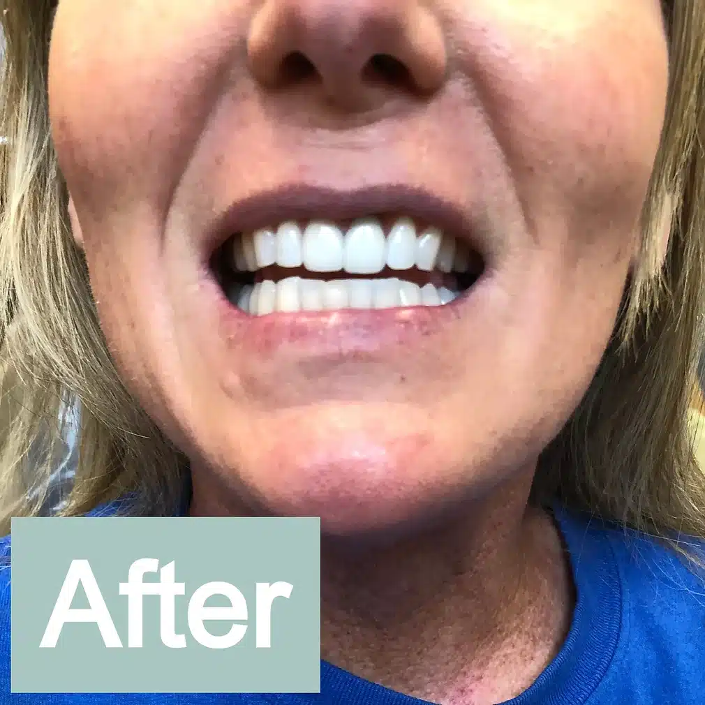 Twin Branch Dental Dental, 309 Bittersweet Road #105 Mishawaka, IN 46544, Emergencies Same Day, Clear Aligners, Orthodontics, Orthodontist, Teeth Whitening, Same Day Wisdom Tooth Extractions, Same Day Endodomtics, Endodontist, Root Canals, dental veneers, implants, implant, crown, crowns, veneer, Bridges, bridge, fillings, sealants flouride treatment, dental exams, x-rays, teeth cleanings, childs first dental visit, General dentistry, emergency dentistry, cosmetic dentistry, restorative dentistry, preventative dentistry, dentures, denture partial full, periodontal therapy, sedation dentistry, Dr. Mike Hewlett and Dr. Andrew Zaremba
