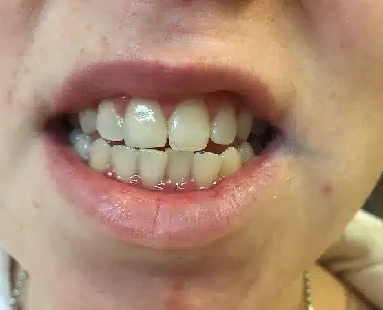 Twin Branch Dental Dental, 309 Bittersweet Road #105 Mishawaka, IN 46544, Emergencies Same Day, Clear Aligners, Orthodontics, Orthodontist, Teeth Whitening, Same Day Wisdom Tooth Extractions, Same Day Endodomtics, Endodontist, Root Canals, dental veneers, implants, implant, crown, crowns, veneer, Bridges, bridge, fillings, sealants flouride treatment, dental exams, x-rays, teeth cleanings, childs first dental visit, General dentistry, emergency dentistry, cosmetic dentistry, restorative dentistry, preventative dentistry, dentures, denture partial full, periodontal therapy, sedation dentistry, Dr. Mike Hewlett and Dr. Andrew Zaremba