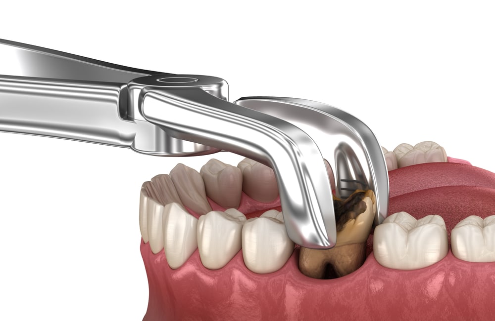 The Ultimate Guide to Same-Day Extractions: Everything You Need to Know Mishawaka Same Day Tooth Extractions Twin Branch Dental Dental, 309 Bittersweet Road #105 Mishawaka, IN 46544, Emergencies Same Day, Clear Aligners, Orthodontics, Orthodontist, Teeth Whitening, Same Day Wisdom Tooth Extractions, Same Day Endodomtics, Endodontist, Root Canals, dental veneers, implants, implant, crown, crowns, veneer, Bridges, bridge, fillings, sealants flouride treatment, dental exams, x-rays, teeth cleanings, childs first dental visit, General dentistry, emergency dentistry, cosmetic dentistry, restorative dentistry, preventative dentistry, dentures, denture partial full, periodontal therapy, sedation dentistry, Dr. Mike Hewlett and Dr. Andrew Zaremba
