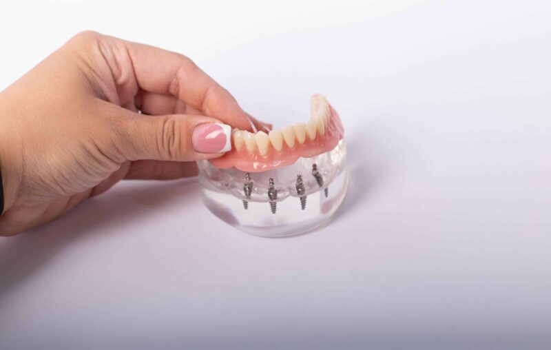 Implant-Supported Dentures Mishawaka